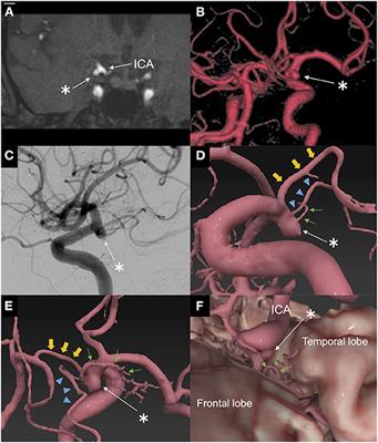 Case Report: “Clipping” an Internal Carotid Artery Aneurysm With a Duplicated Middle Cerebral Artery and the Anterior Choroidal Artery Arising From the Dome